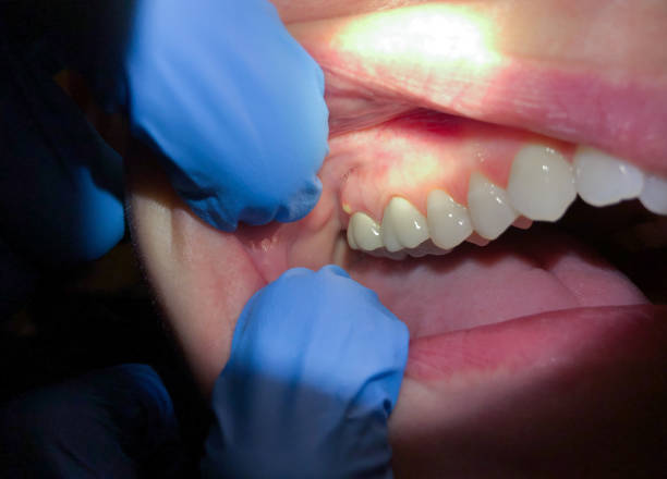 Best Emergency Wisdom Tooth Extraction in Elk River, MN
